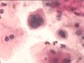 TCT报告：报了ASC-H，现送活检，请大家帮忙看看。图9