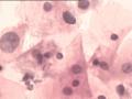 TCT报告：报了ASC-H，现送活检，请大家帮忙看看。图5