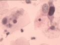 TCT报告：报了ASC-H，现送活检，请大家帮忙看看。图13