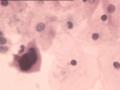 TCT报告：报了ASC-H，现送活检，请大家帮忙看看。图15