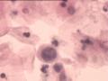 TCT报告：报了ASC-H，现送活检，请大家帮忙看看。图10