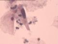TCT报告：报了ASC-H，现送活检，请大家帮忙看看。图8