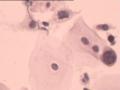 TCT报告：报了ASC-H，现送活检，请大家帮忙看看。图3