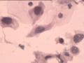 TCT报告：报了ASC-H，现送活检，请大家帮忙看看。图1