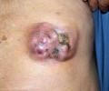 男性乳腺肿块细针穿刺--上传细胞块及免疫组化图1