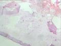 右侧外耳道新生物图5
