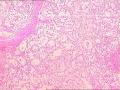 膝关节上方肌间肿物图1