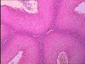 女，25岁，宫颈菜花状肿物图8