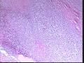 F/32，颈部淋巴结。补充照片和免疫组化结果。图12