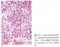 F/32，颈部淋巴结。补充照片和免疫组化结果。图28