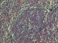 左上肺结节，公布最后诊断图5