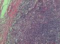 左上肺结节，公布最后诊断图10