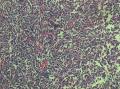 左上肺结节，公布最后诊断图6