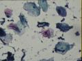 TCT ,46岁，请老师帮我看看图1