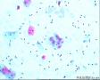 是炎症引起还是ASC-US？图1