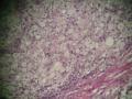 54岁女性，手部肿物，皮下，包膜完整图5