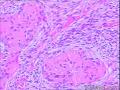 腹膜后肿瘤图12