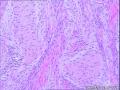 腹膜后肿瘤图13