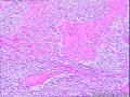 腹膜后肿瘤图6