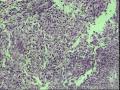 支气管活检，患者，男性，66岁，支气管镜下见息肉样新生物，鳞癌吗？请各位老师指教！图2