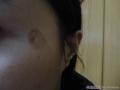 29岁女性的颞侧黑斑片的诊断图1