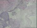 功血，滋养细胞浅肌层？图8