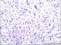 外耳道新生物图4