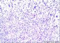 外耳道新生物图5