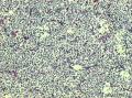 腹膜后占位位性病变，结果公布图1