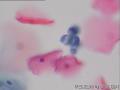 宫颈液基  32岁  有上环史图8
