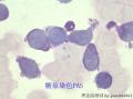 女 骨髓 淋系 还是髓系呢 幼稚单核还是幼稚淋巴？图13