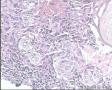 喉新生物   癌？图5