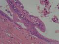 阑尾粘液性腺癌图17