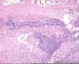 48岁男性,HE求教！颌下肿物3*2*2CM质硬，腮腺 肿物9*5*4CM 。原来冰冻求教，现将腮腺切片图1-29，图30以后腮腺部淋巴结图21