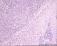 48岁男性,HE求教！颌下肿物3*2*2CM质硬，腮腺 肿物9*5*4CM 。原来冰冻求教，现将腮腺切片图1-29，图30以后腮腺部淋巴结图10