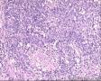 48岁男性,HE求教！颌下肿物3*2*2CM质硬，腮腺 肿物9*5*4CM 。原来冰冻求教，现将腮腺切片图1-29，图30以后腮腺部淋巴结图4