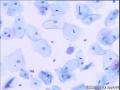 宫颈TCT，31岁，3个月前HPV16阳性图4