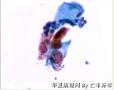 体检，42岁，请大家欣赏并讨论图14