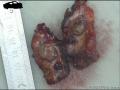腹膜后肿物图18