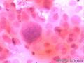 求助：乳腺穿刺HE染色，是乳腺癌吗？没发报告！图17