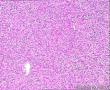 男，72岁，胸壁肿块，1215442图2