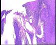 龟头肿物，怎么诊断是好？已经有结果：疣状癌图4