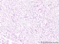 求助：由于肌瘤体积较大，有点不放心！请大家帮我看一下，有没问题？图1