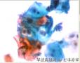 HPV感染图12