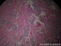 男，60岁，下颌前牙区包块半月，体积2.5cmx2cmx1cm，临床诊断牙龈瘤图3