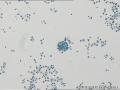女 60岁  卵巢癌？  送检腹水图5