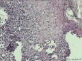 左下眼睑肿物，怎么诊断呢？图27