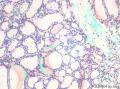 甲状腺滤泡性腺瘤？图11