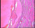结甲？还是巨滤泡性腺瘤？图7