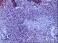 宫颈赘生物图2